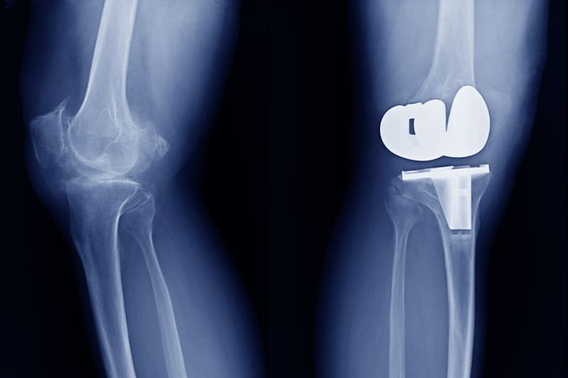 Prótesis de rodilla